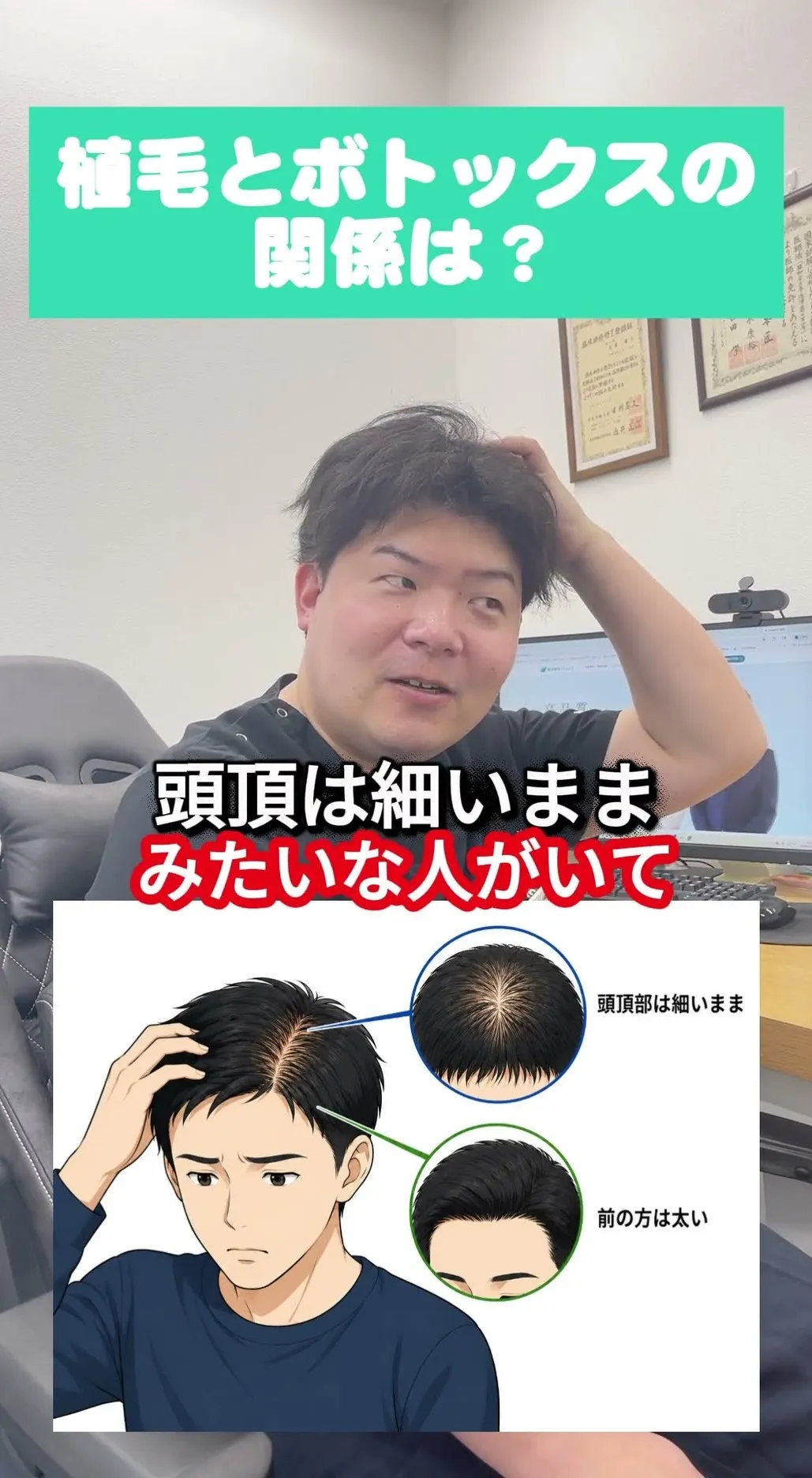 植毛とボトックスの関係は？（動画を見る）