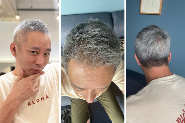 植毛から6ヶ月経過