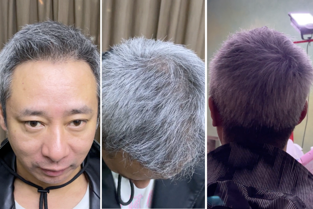 植毛から9ヶ月経過