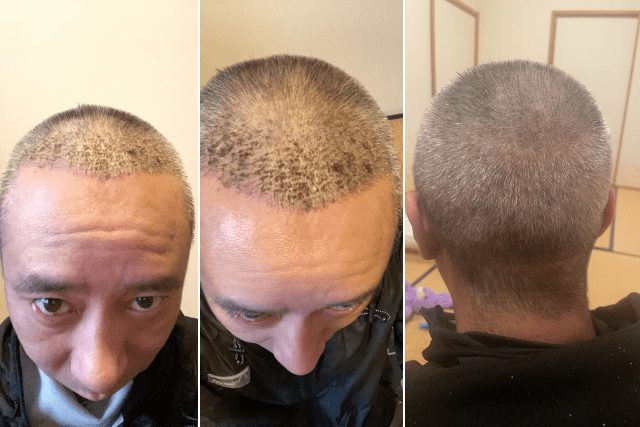 自毛植毛後1週間の経過|頭皮の赤み・かさぶた
