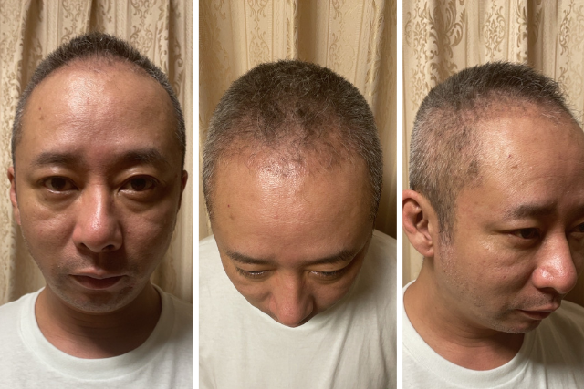 自毛植毛後2ヶ月目の経過|植毛部位と既存毛とのバランス