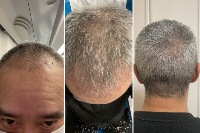 自毛植毛後3週間〜1ヶ月の経過|頭皮の回復・抜け毛の始まり