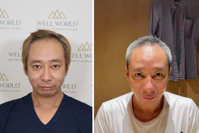 【植毛の経過】いしだ壱成さんの自毛植毛3ヶ月後「抜け毛期と見た目の変化」