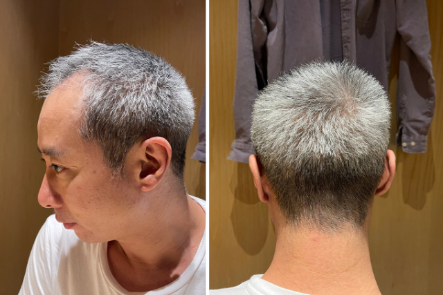 自毛植毛3ヶ月後の経過②|植毛部位とドナー採取部分の状態