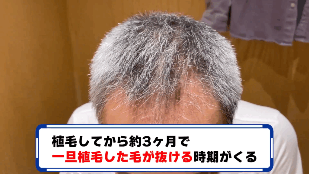 自毛植毛3ヶ月後の経過①|抜け毛期でも「全部は抜けなかった」