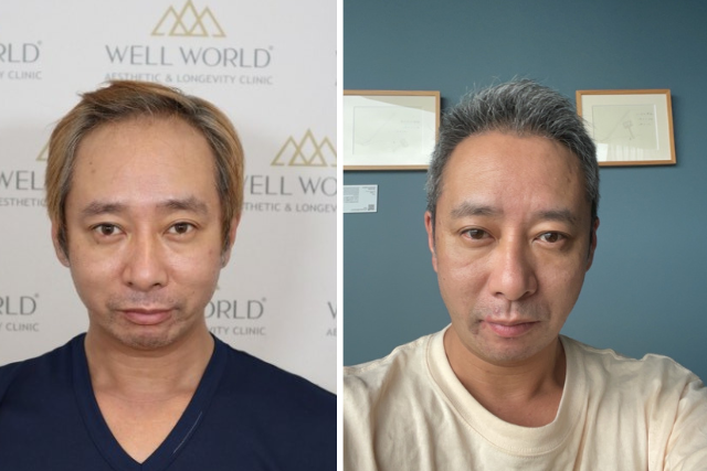 【植毛の経過】いしだ壱成さんの自毛植毛6ヶ月後「完成へ向けての折り返し」