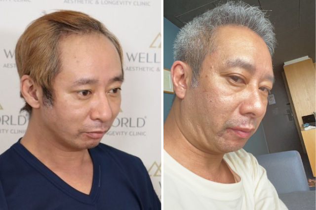 自毛植毛6ヶ月後の経過③|ここから始まる「発毛の本格期」