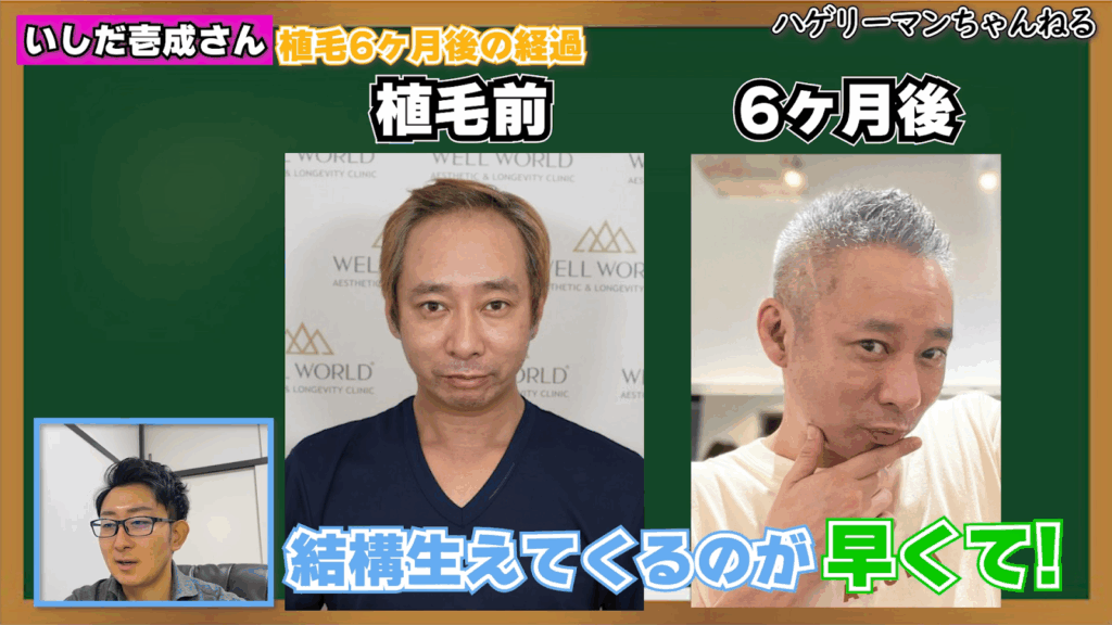 自毛植毛6ヶ月後の経過①|生え際に変化が見られ始める