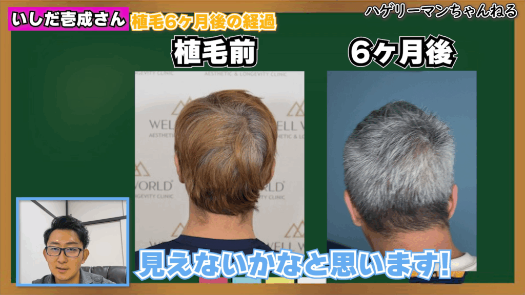 ドナー採取部分(後頭部)も問題なし