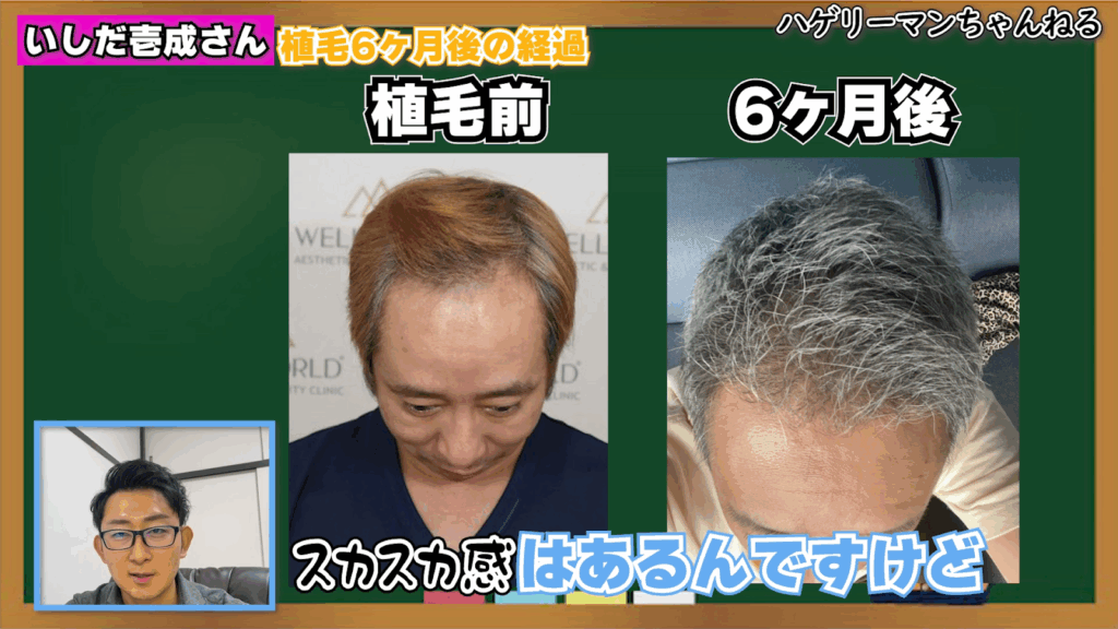 自毛植毛6ヶ月後の経過②|毛の密度はまだ少ない