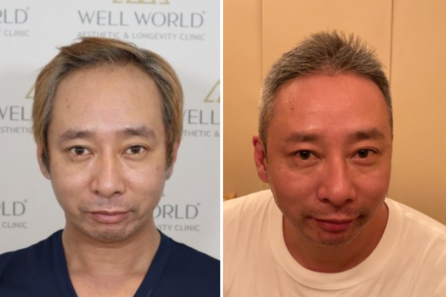 【植毛の経過】いしだ壱成さんの自毛植毛8ヶ月後「モテ期再来と芝居の変化」