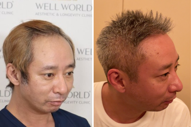 自毛植毛8ヶ月後の経過①|外見だけでなく人生まで変わった