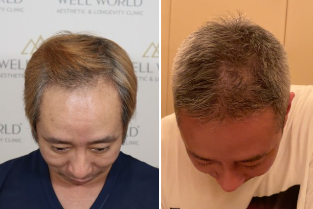 自毛植毛8ヶ月後の経過②|薄毛時代からの逆転劇