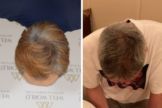 自毛植毛8ヶ月後の経過③|外見が変わると自信も変わる