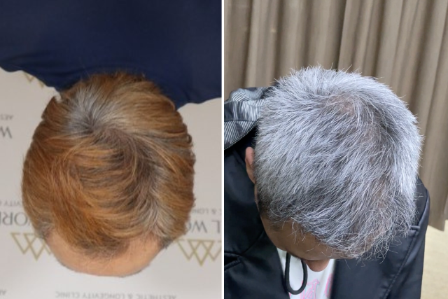 自毛植毛9ヶ月後の経過③|髪の自然さと自信を取り戻す時期