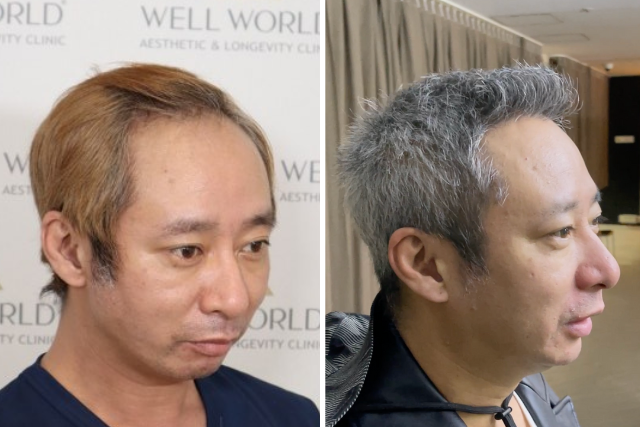 自毛植毛9ヶ月後の経過①|髪全体のシルエットが大きく変化