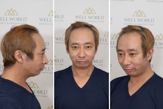 いしだ壱成さんが自毛植毛を選んだきっかけとは?