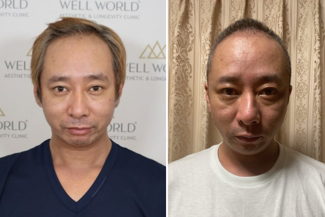 【植毛の経過】いしだ壱成さんの植毛直後〜2ヶ月目「かさぶたと抜け毛」