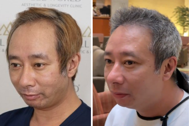 自毛植毛から1年後の経過②｜自毛植毛をきっかけに芸能活動が再び加速