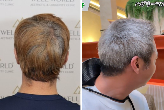 自毛植毛から1年後の経過③｜隠れる人生から輝く人生へ