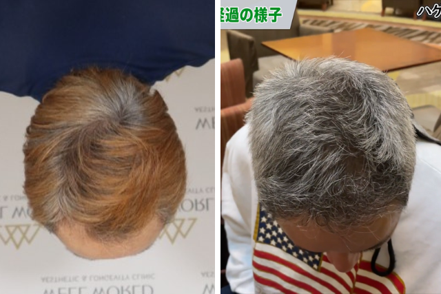 自毛植毛1年後の成果を確実にするための3つのポイント