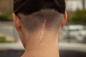 傷跡に毛が生えない原因とは？？毛が生えない理由と自毛植毛でカバーできる条件