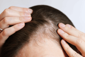 「人工毛植毛」とは？自毛植毛との違いや植毛の仕組み・費用相場を解説