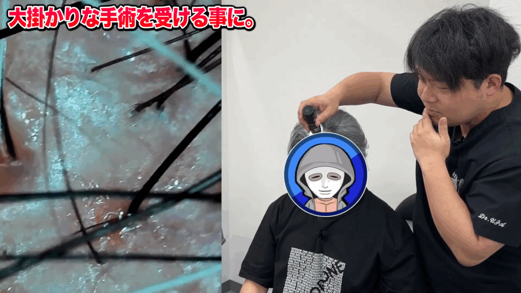 ラファエルさんが受けた植毛手術「FUE」で重要な株分け（株磨き）とは？クリニック選びのポイント