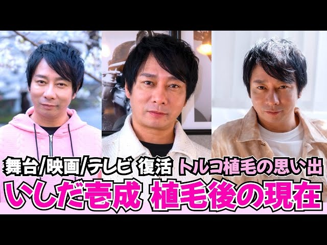 いしだ壱成さんが行った「自毛植毛」とその体験談　