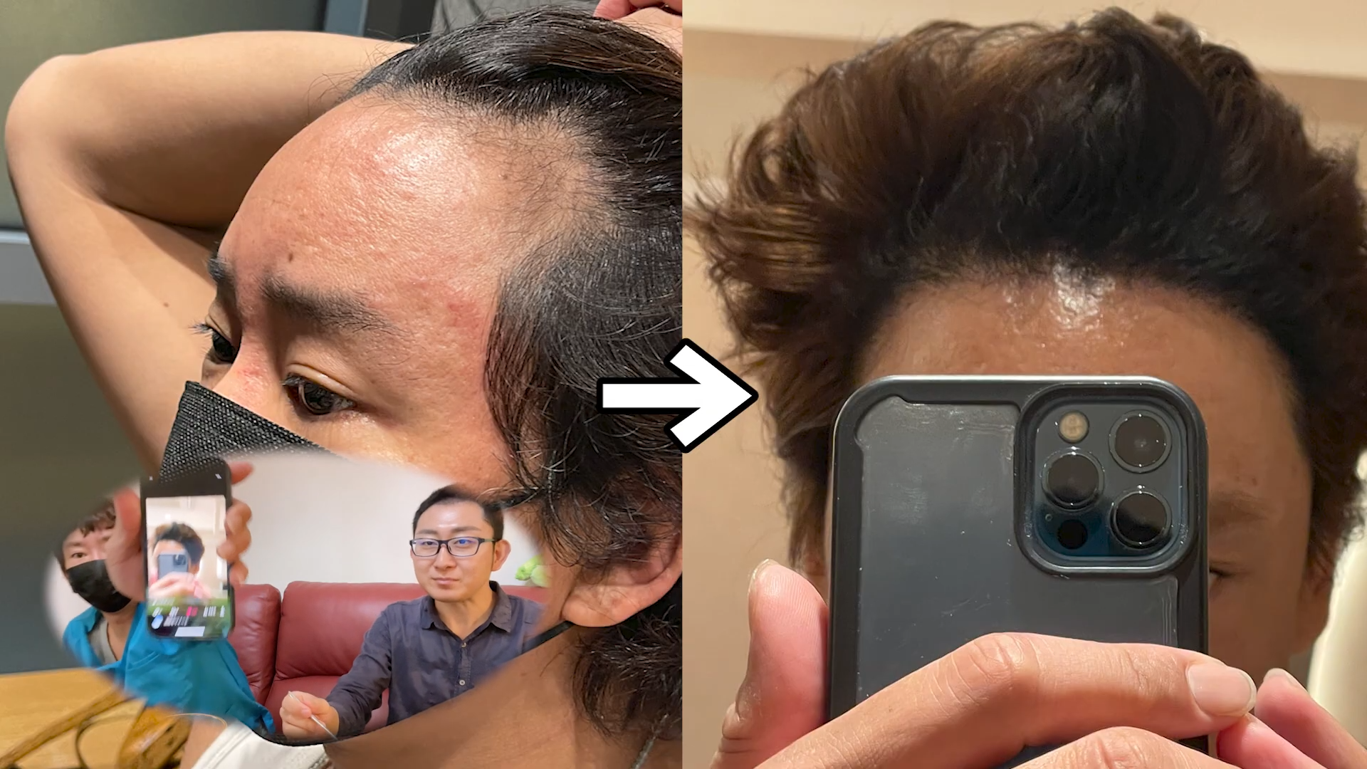 植毛から6ヶ月経過した楽しんごさんの髪の状態は?