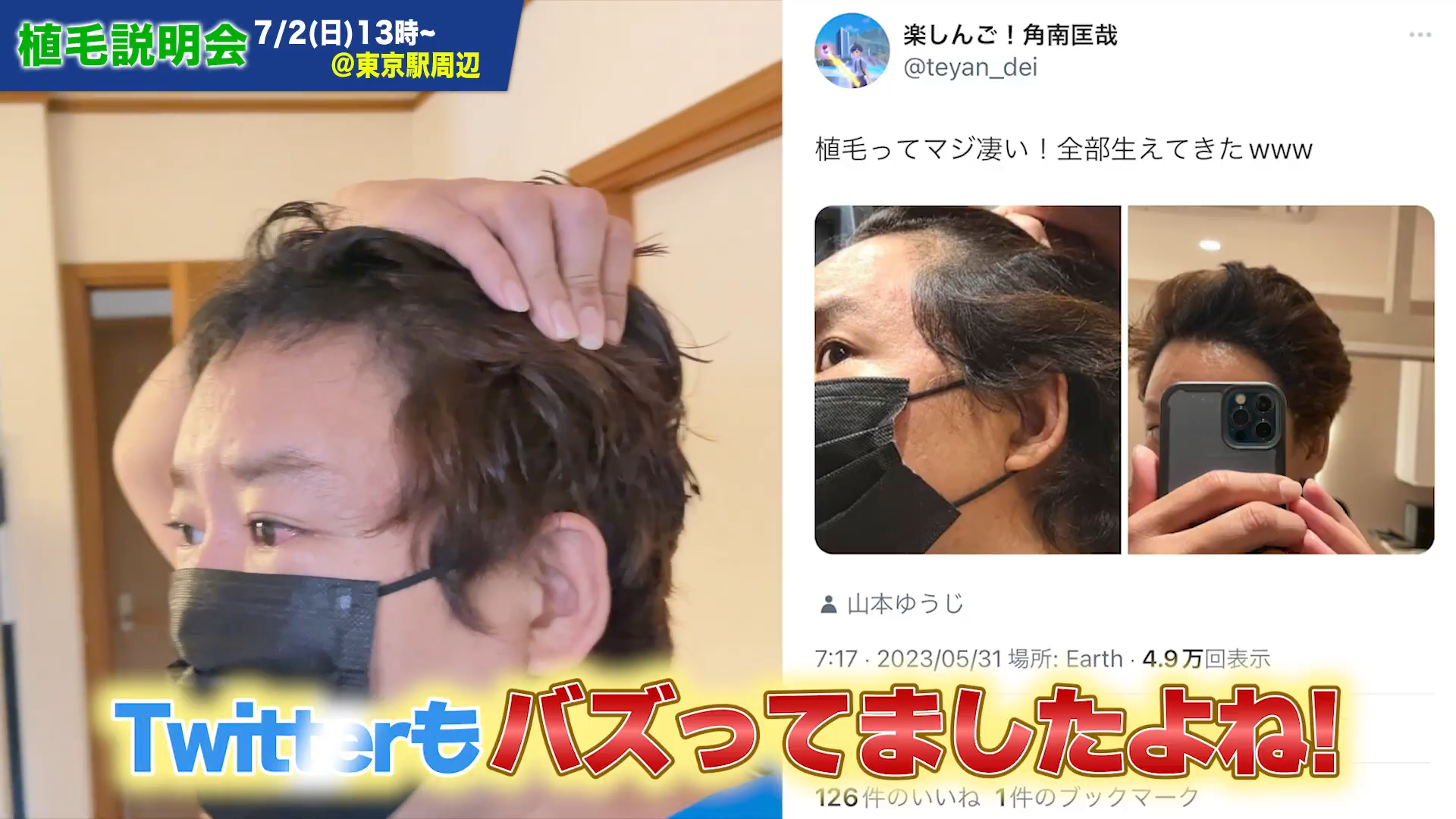 楽しんごさんの植毛体験は薄毛に悩む多くの方から反響があった