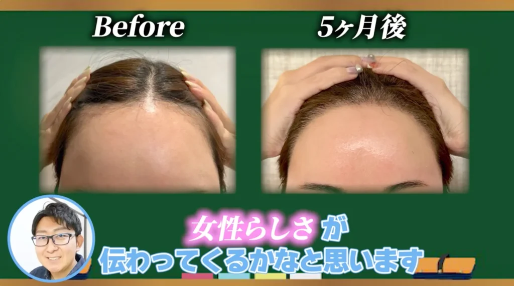 女性の間で注目される「おでこ植毛」とは?