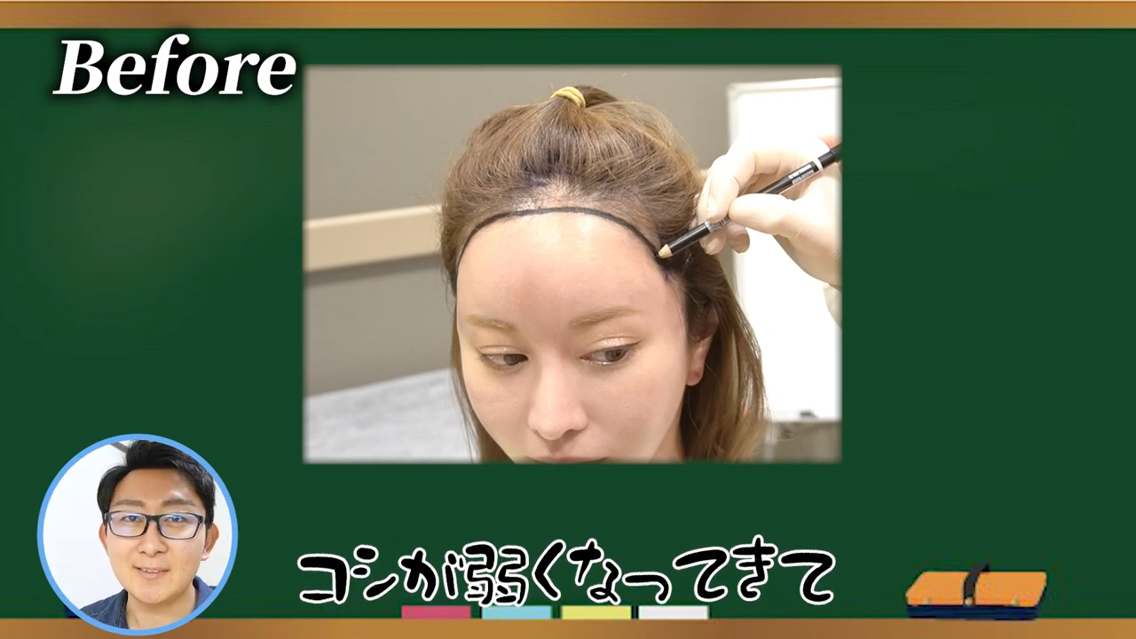 美容整形ちゃんの植毛前の髪の状態