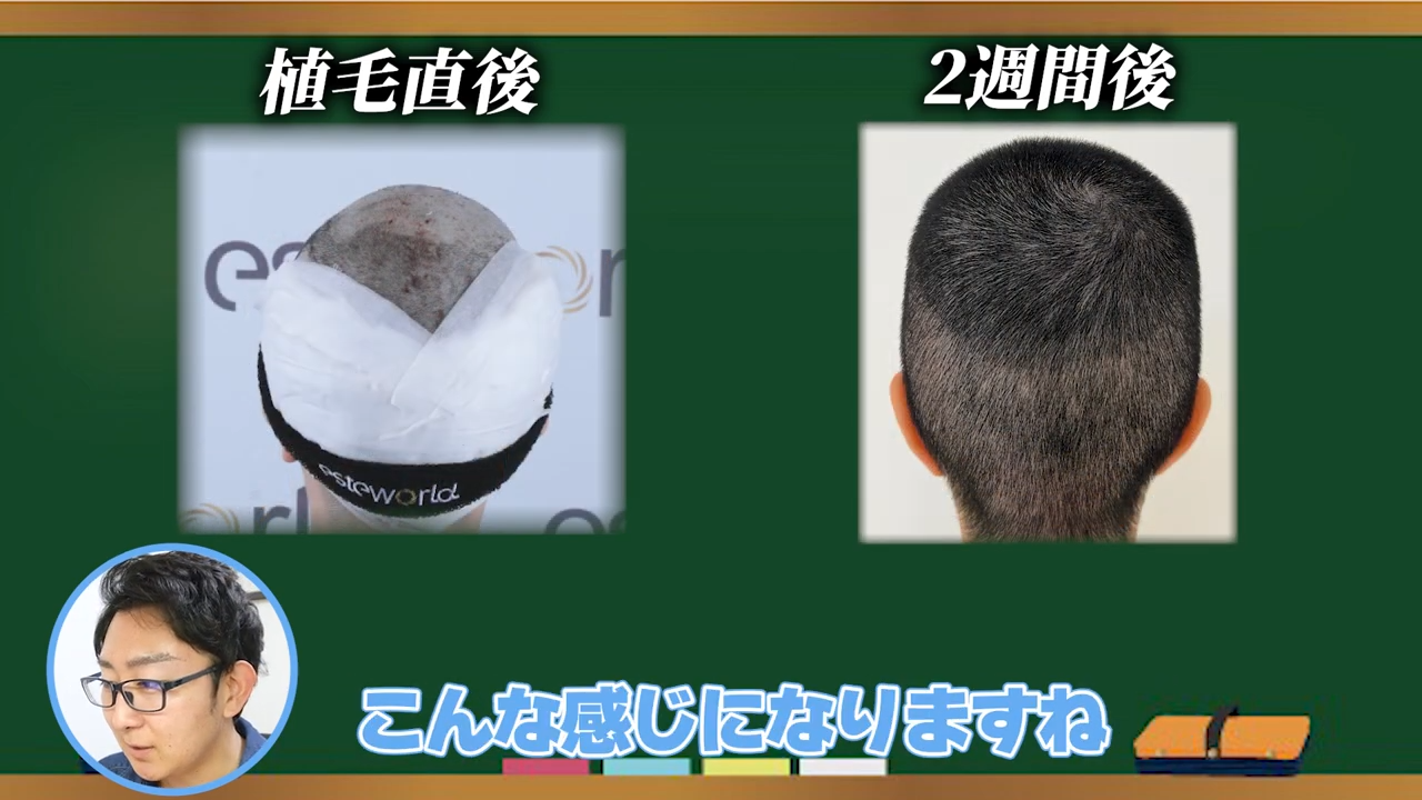 ドナー採取部（後頭部）の状態