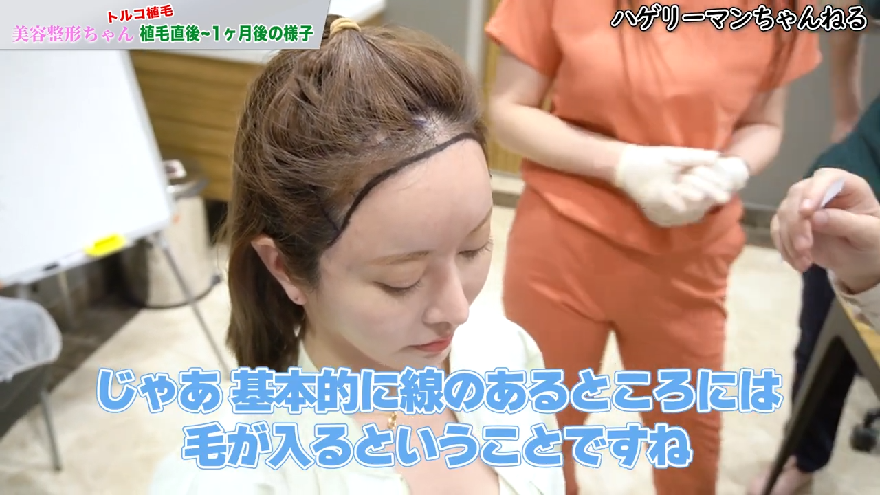 美容整形ちゃんが受けた植毛の施術内容