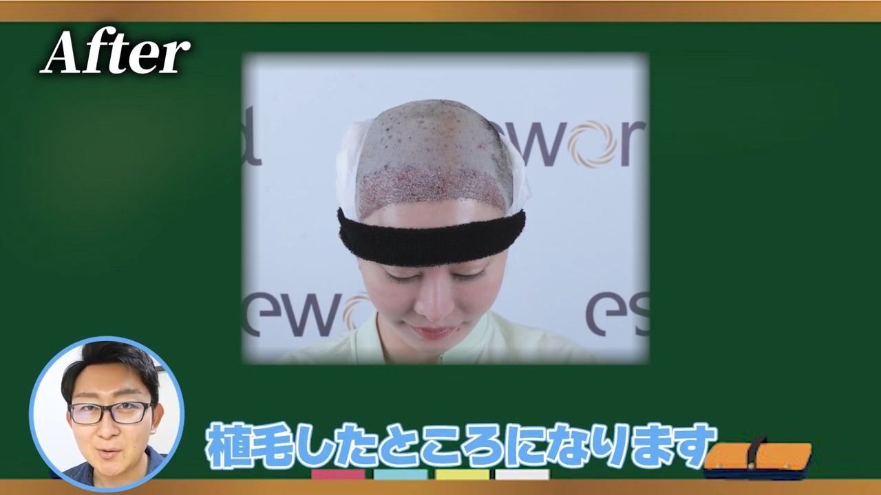 植毛部位とドナー採取部（後頭部）の見た目