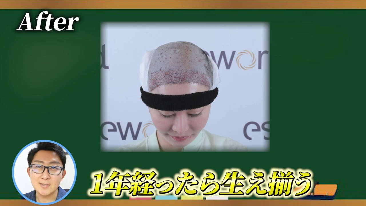 植毛後の髪は今後どう変化していく？