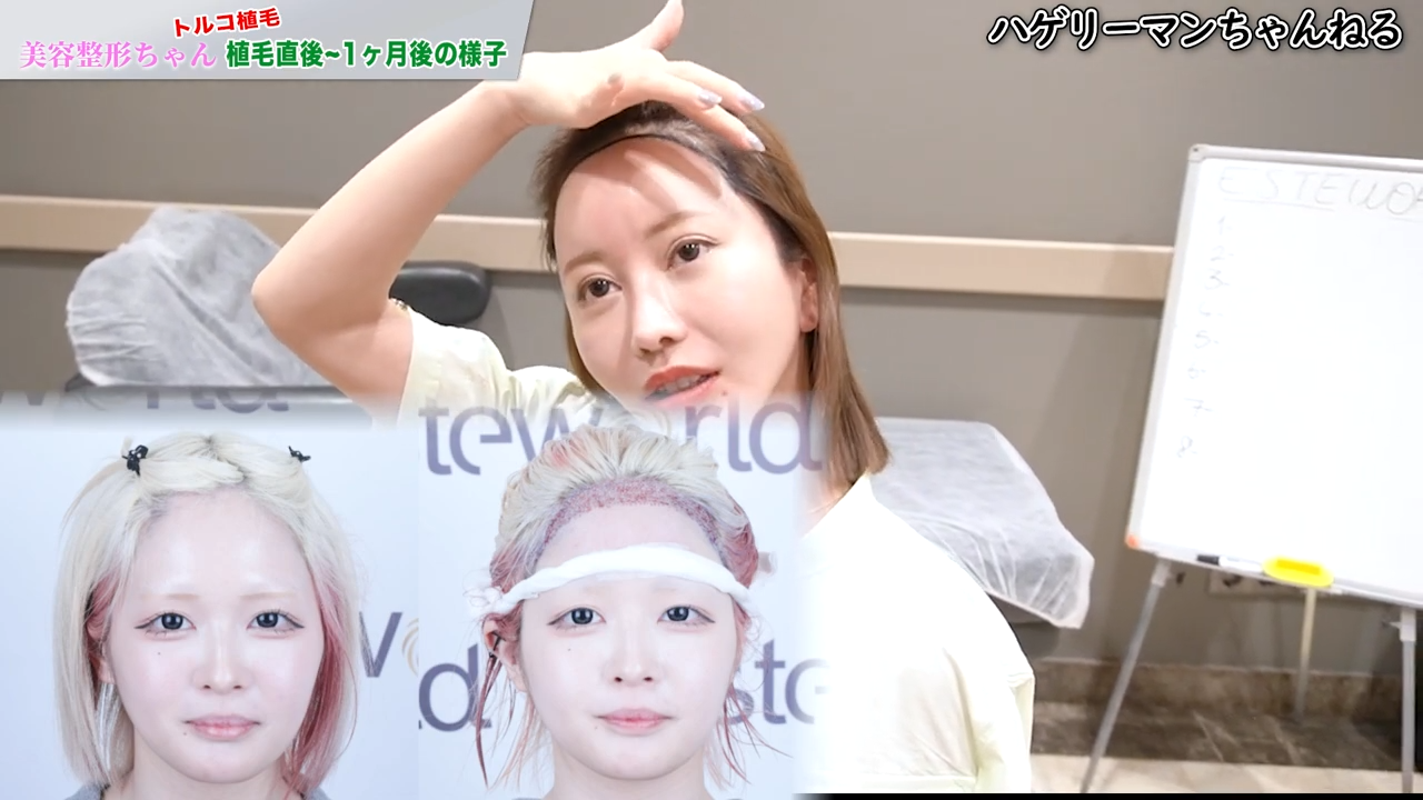 ハウスダストさんの植毛について語る美容整形ちゃん