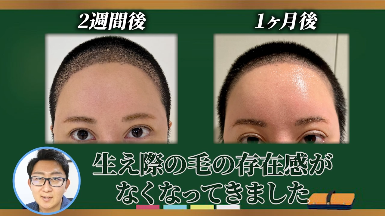 植毛した毛は一度抜けてから生え始める