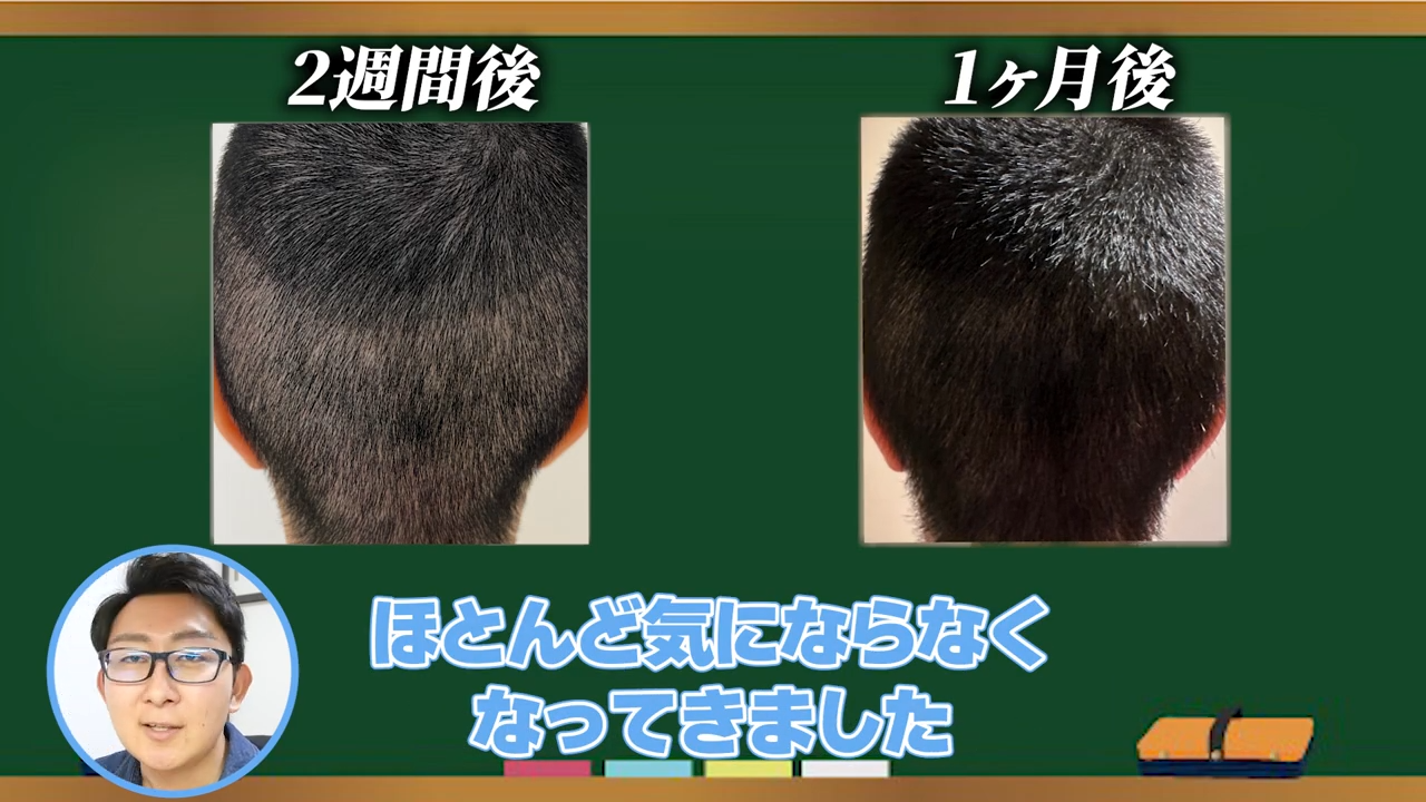 美容整形ちゃんの植毛2週間から1ヶ月経過後のドナー採取部の様子