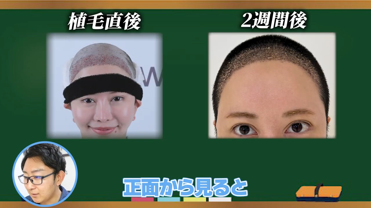 美容整形ちゃんの植毛2週間経過後の状態