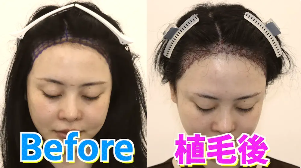 インフルエンサー「レイ」さんの植毛施術当日に密着|美容植毛のデザインや充実のアフターフォローを紹介