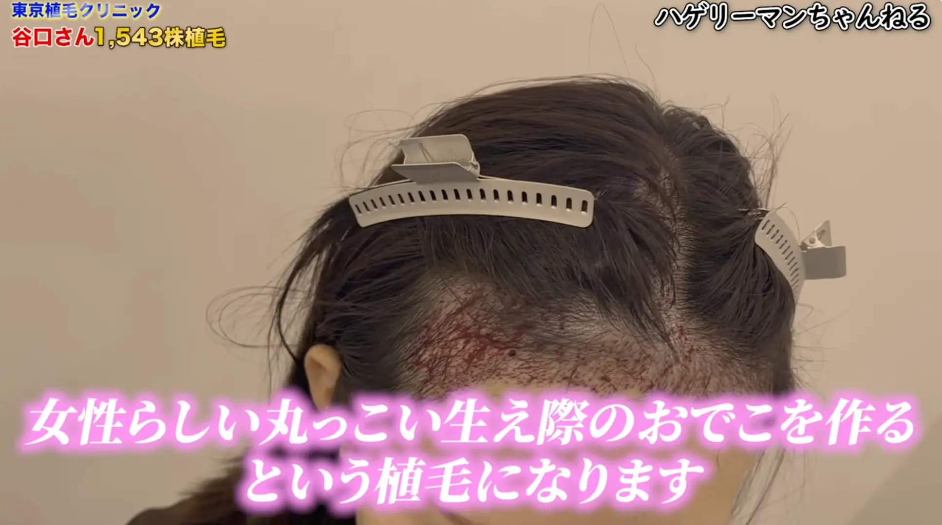 【美容植毛】女性の自毛植毛に密着｜1,500株で叶える理想の「丸くて可愛いおでこ」