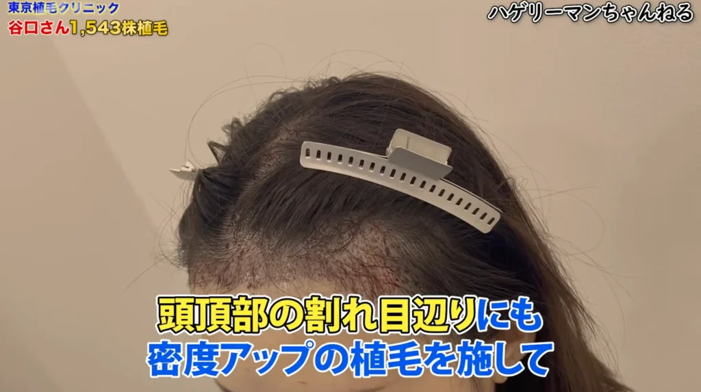 女性のヘアライン矯正ならではのカウンセリングとデザイン