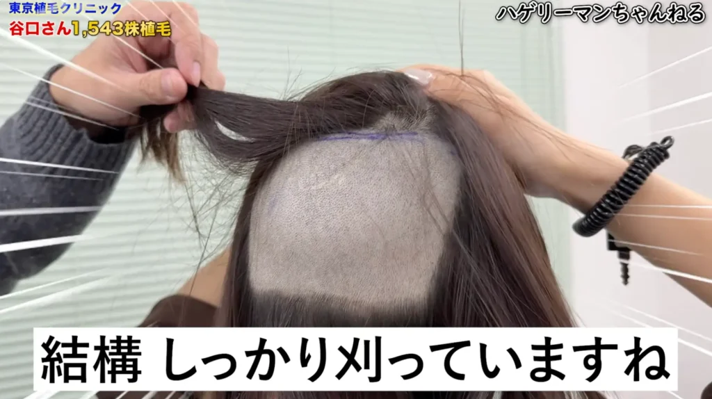 ドナー採取部(後頭部の刈り上げ)の工夫