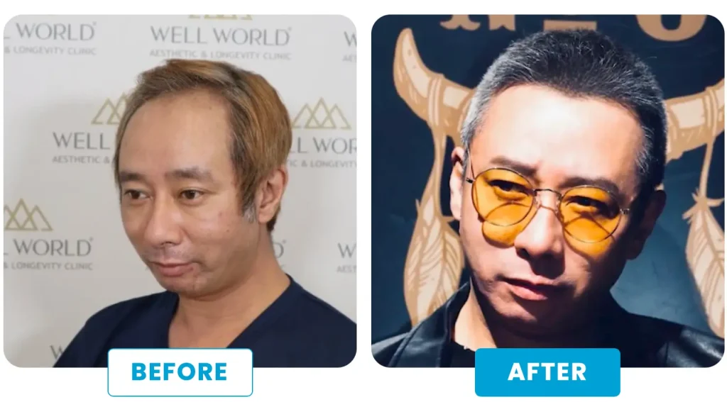 いしだ壱成さん:トルコ植毛で俳優としての自信を回復