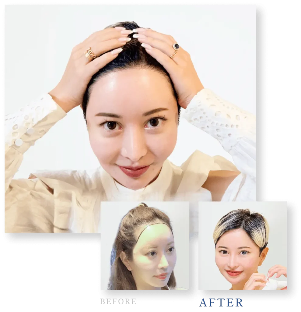 美容整形ちゃん:女性でありながら丸刈りを選択した施術事例