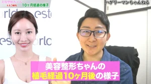 【植毛の経過】「美容整形ちゃん」の自毛植毛10ヶ月後｜コンプレックスを自信に変えた10ヶ月の変化を解説