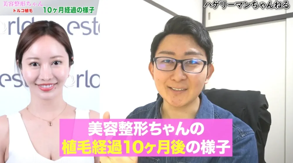 【植毛の経過】「美容整形ちゃん」の自毛植毛10ヶ月後｜コンプレックスを自信に変えた10ヶ月の変化を解説