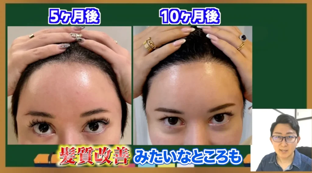 「美容整形ちゃん」も実践!植毛後のヘアケアとメンテナンス